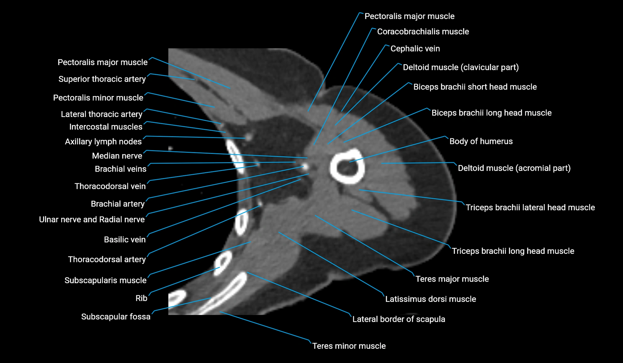 CT upper arm axial  cross sectional anatomy labelled radiology image -00156.webp